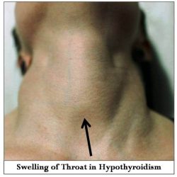thyroid symptoms in hypothyroidism
