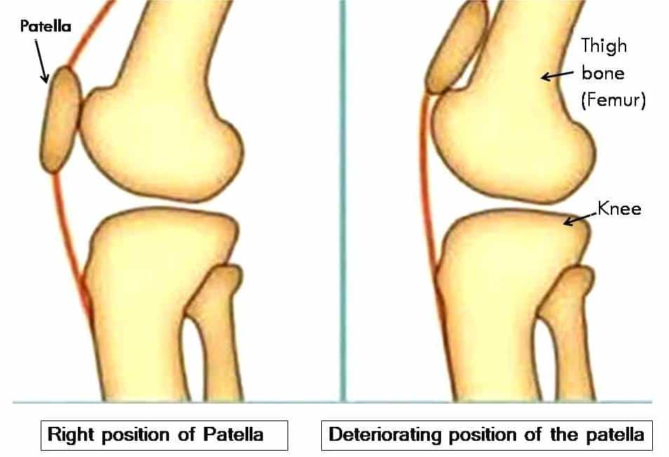 Deteriorating position of patella is the knee pain causes