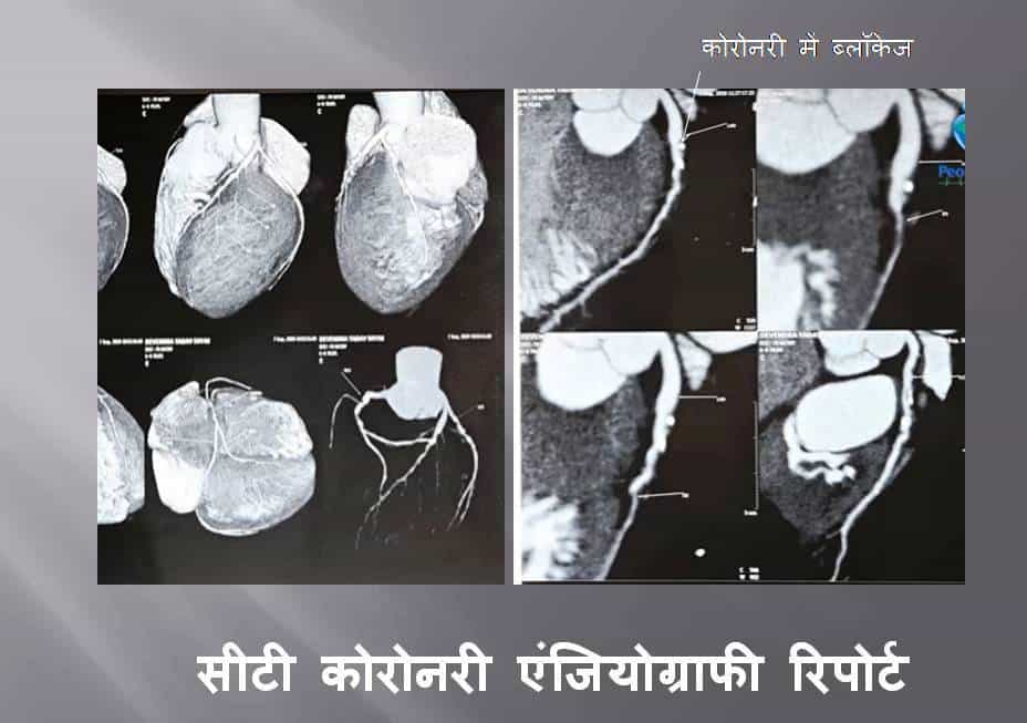 सीटी कोरोनरी एंजियोग्राफी (Ct angiography in hindi)